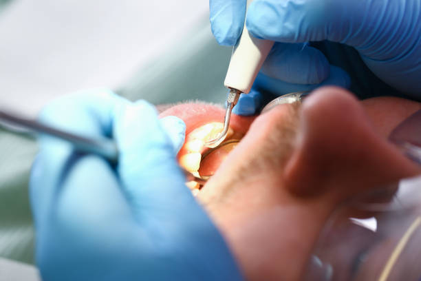 Best Emergency Root Canal Therapy in Bodfish, CA
